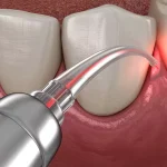 Is Aesthetic Gum Correction A Safe Option For You?