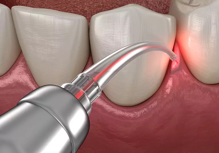 Is Aesthetic Gum Correction A Safe Option For You?